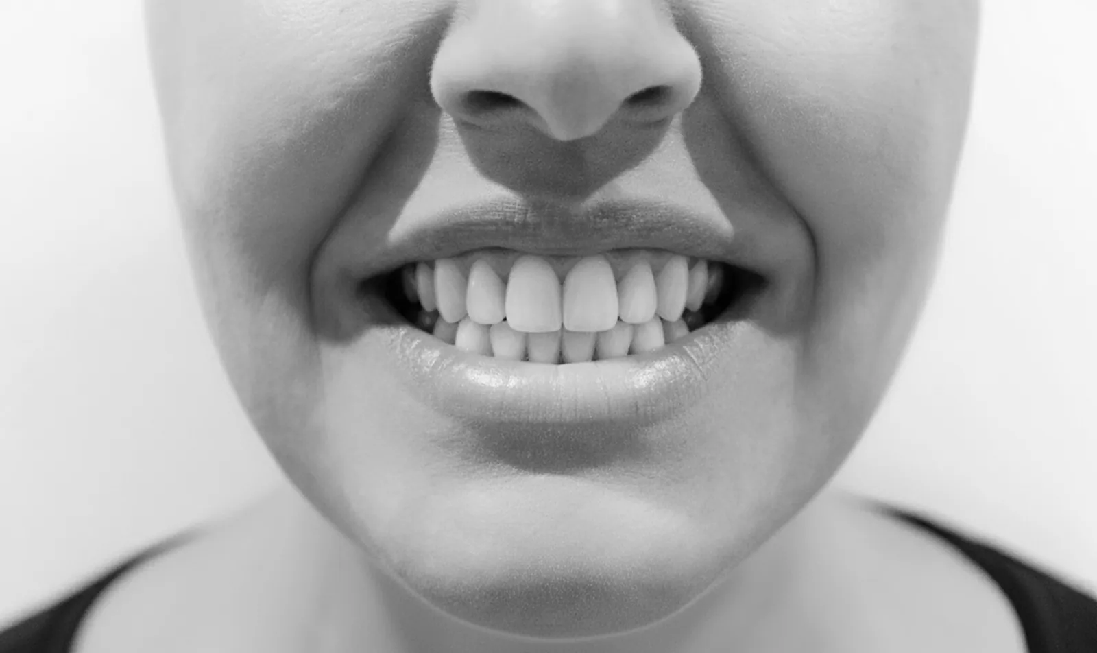 Après traitement orthodontique, dents alignées