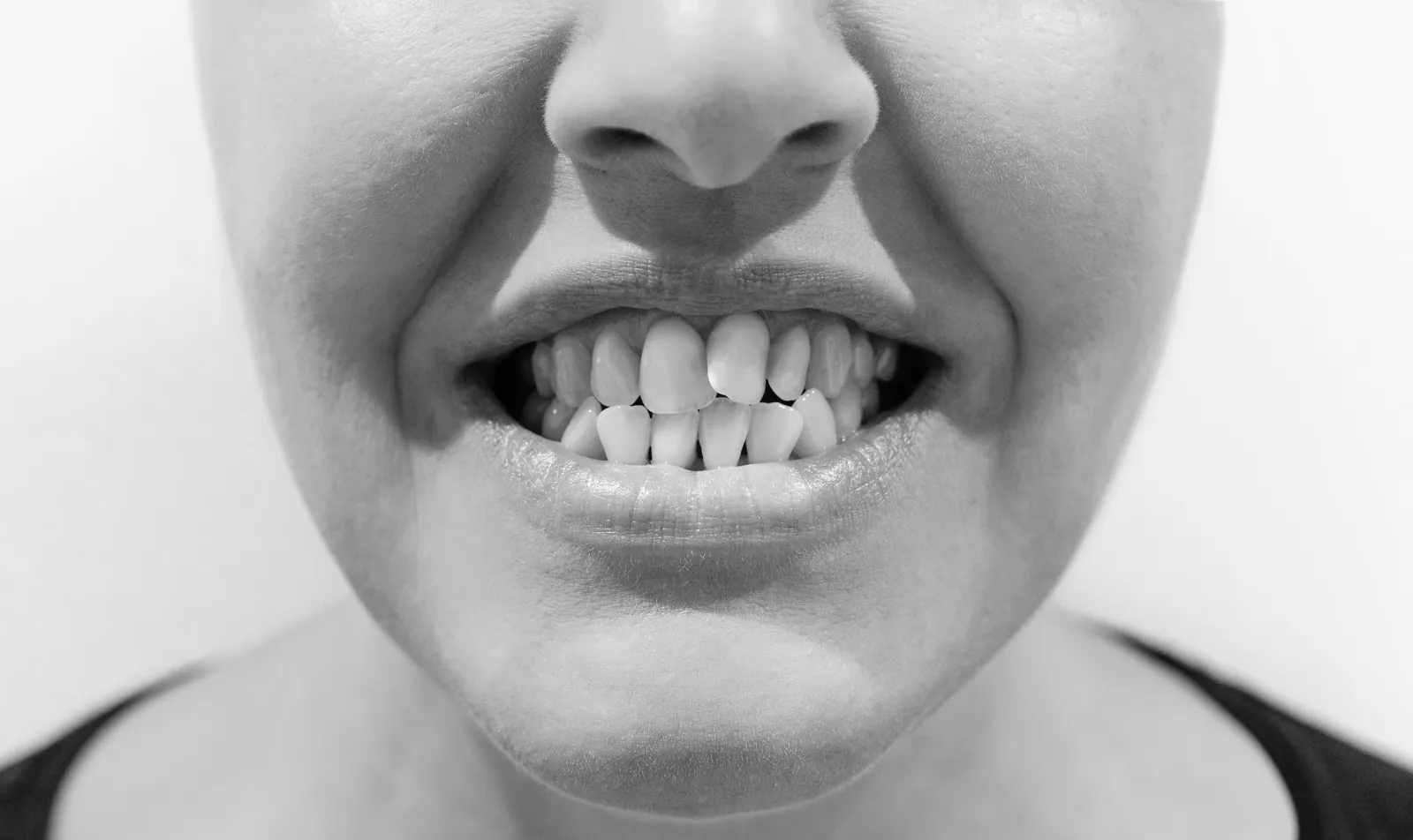Avant traitement orthodontique, dents chevauchées