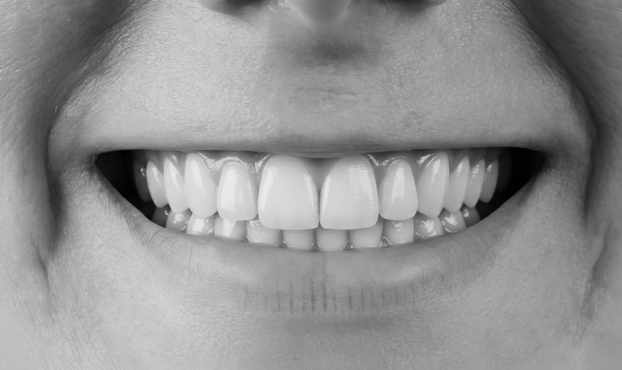 Après traitement orthodontique