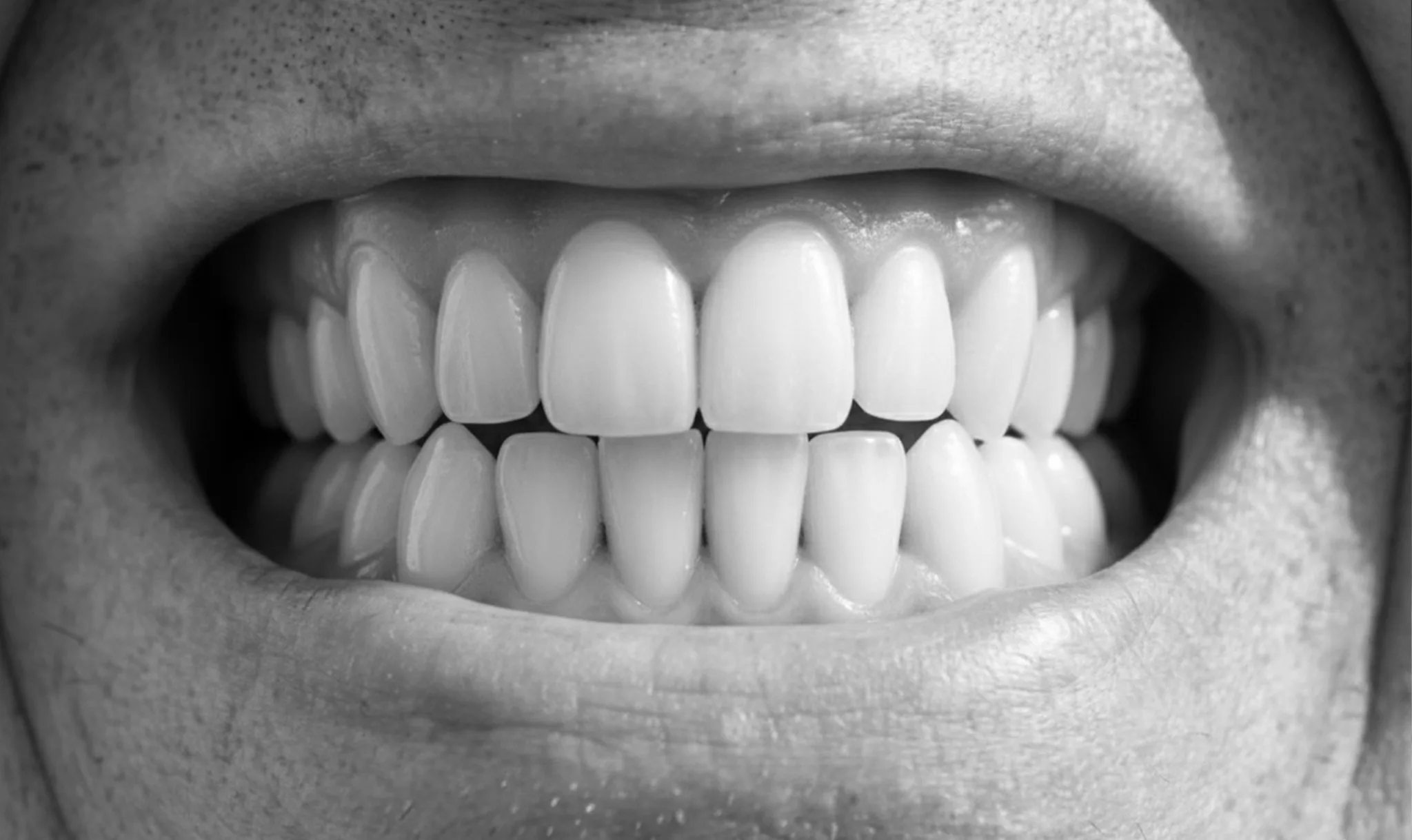Après traitement orthodontique