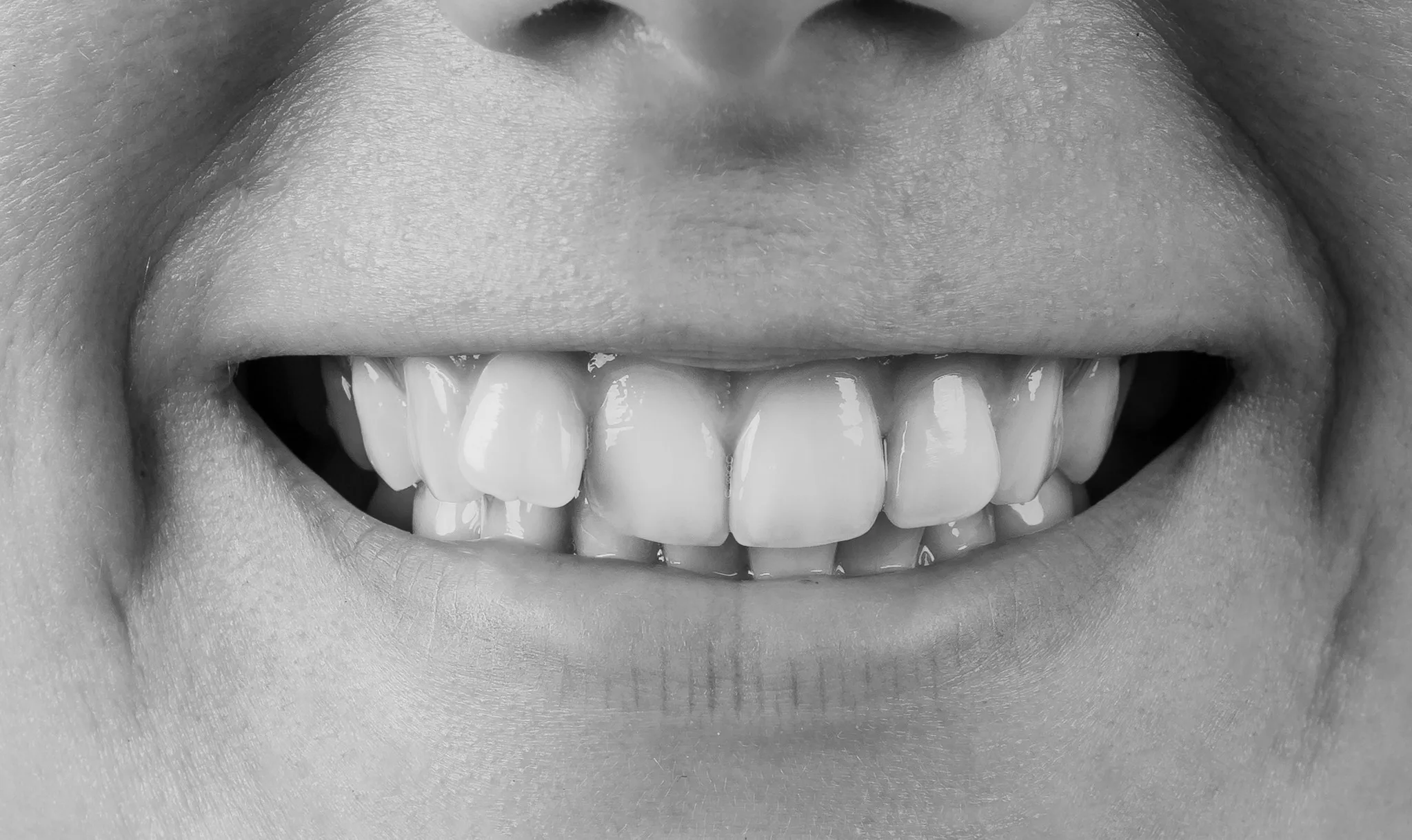 Avant traitement orthodontique