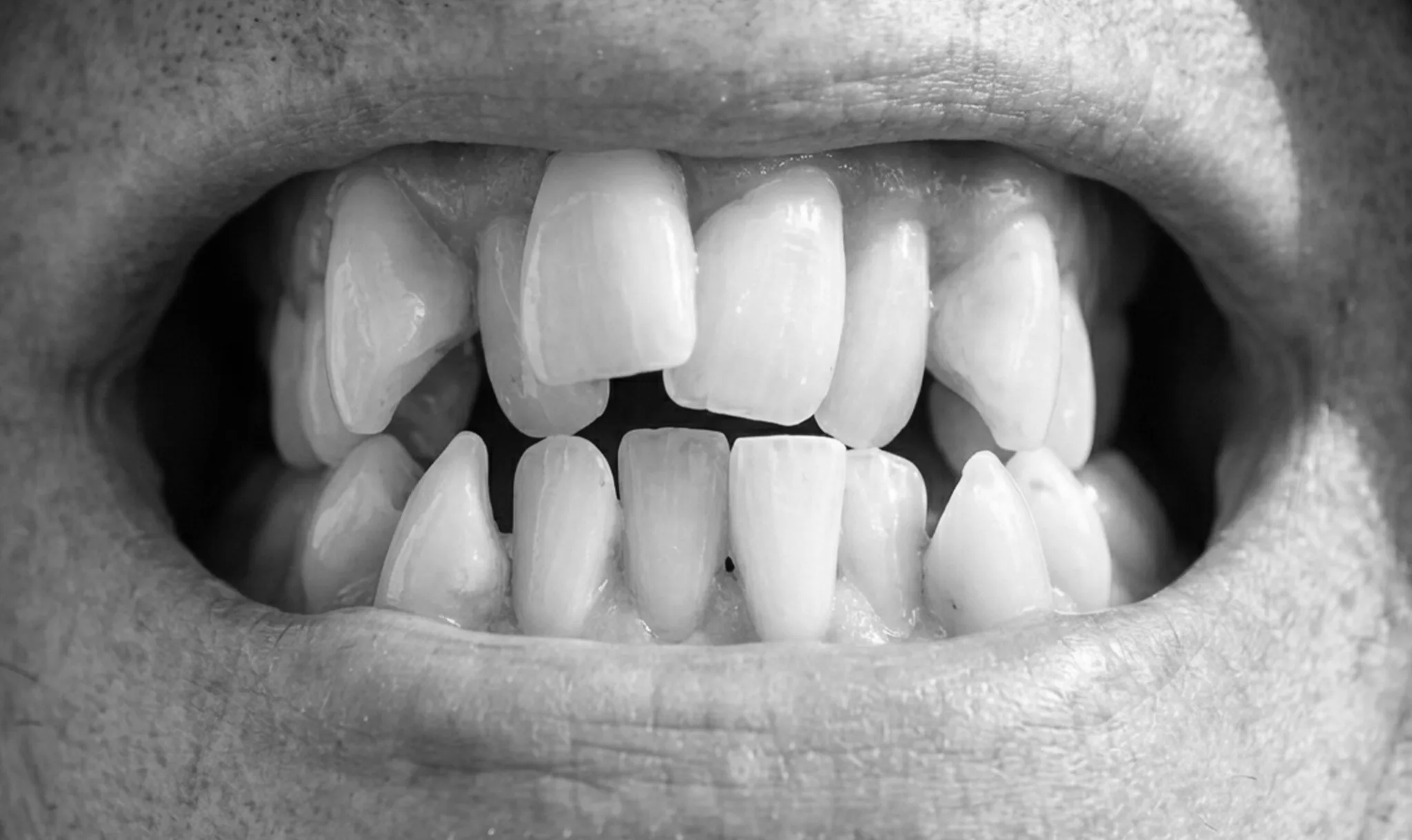 Avant traitement orthodontique