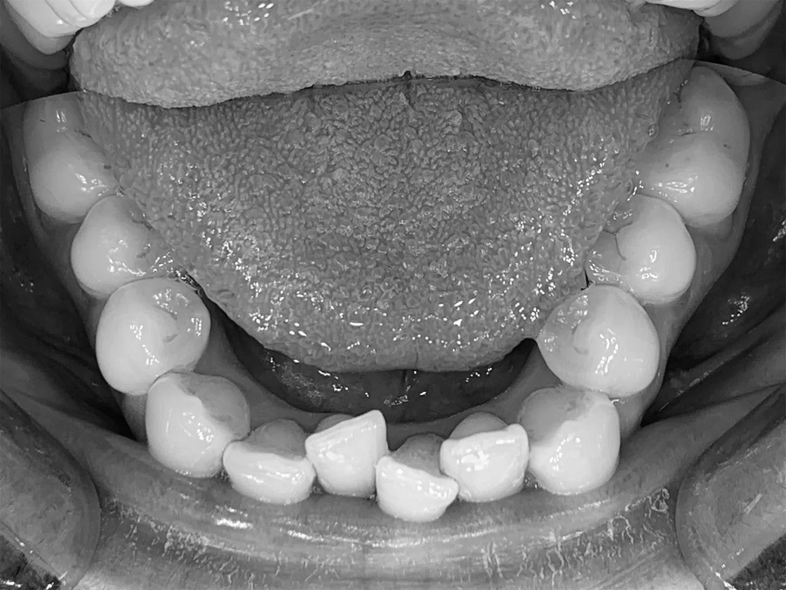 Alignement mandibulaire avant traitement, vue occlusale