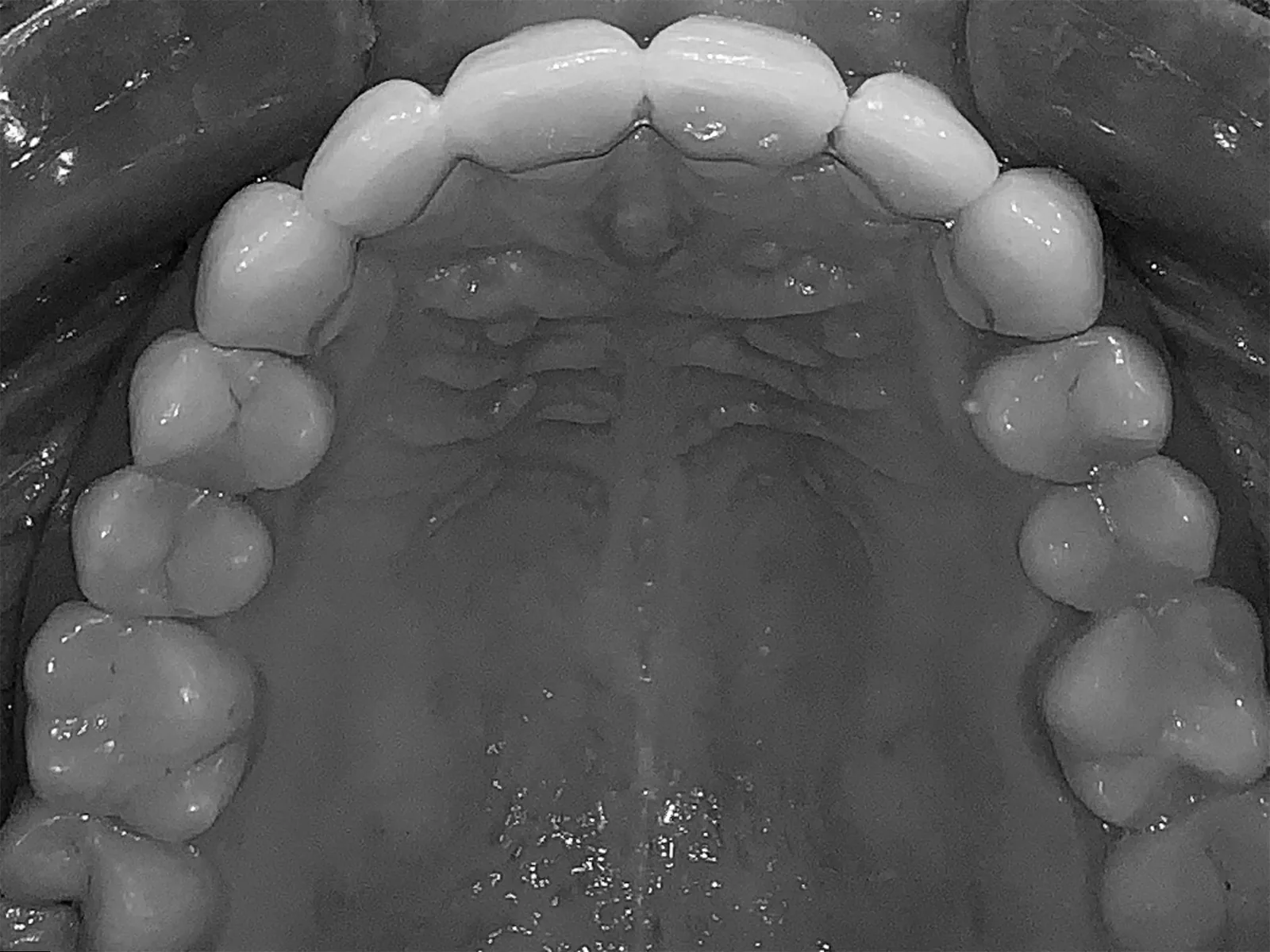 Alignement maxillaire après traitement, vue occlusale