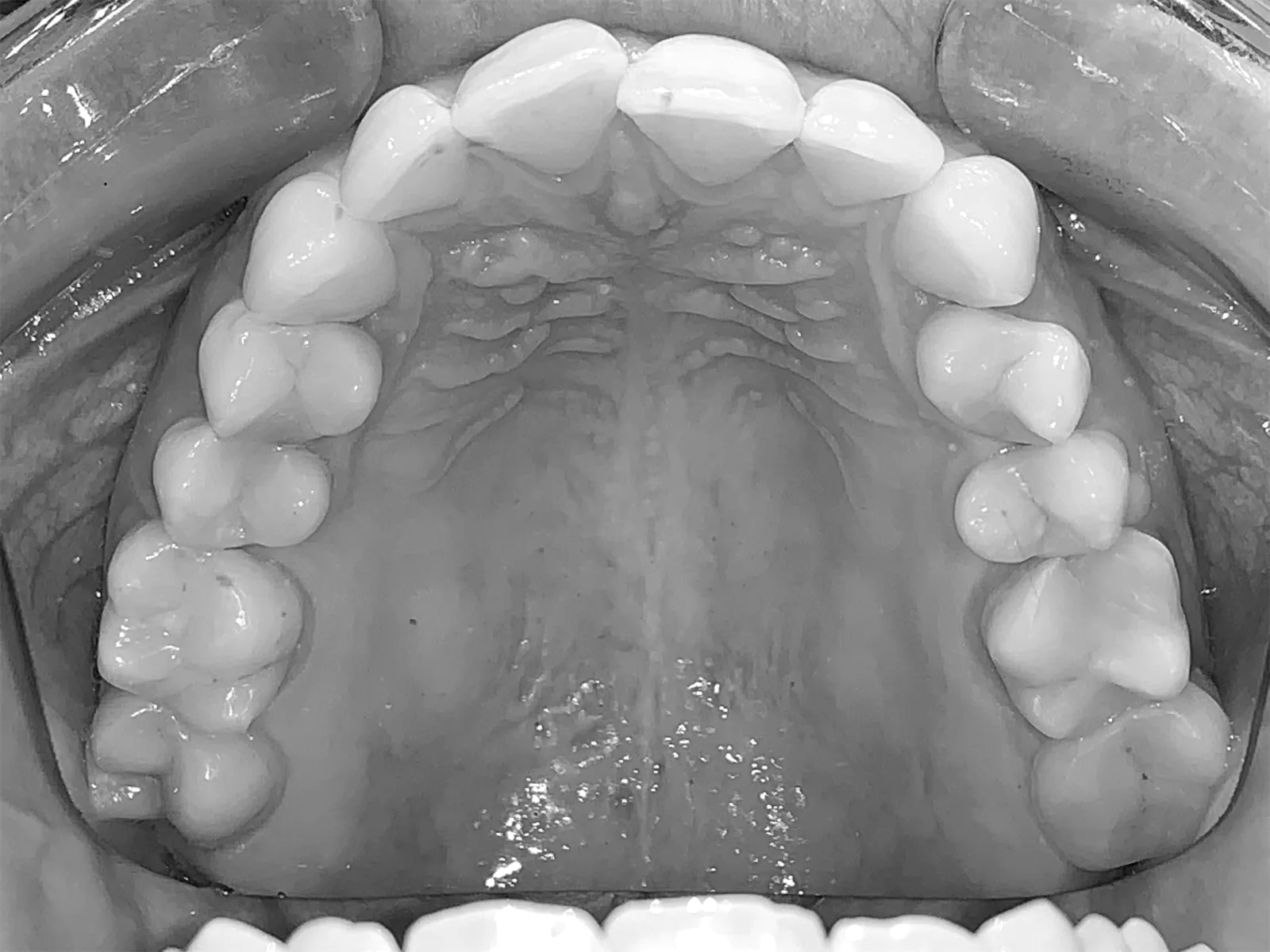 Alignement maxillaire avant traitement, vue occlusale