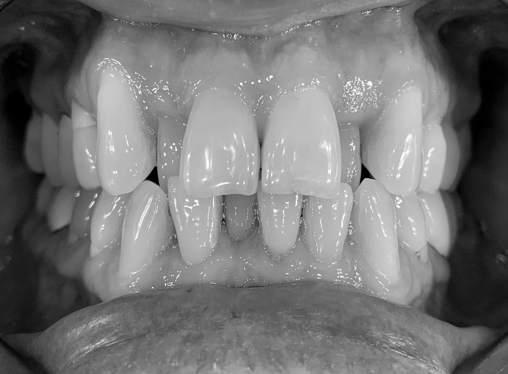 Articulé inversé avant traitement