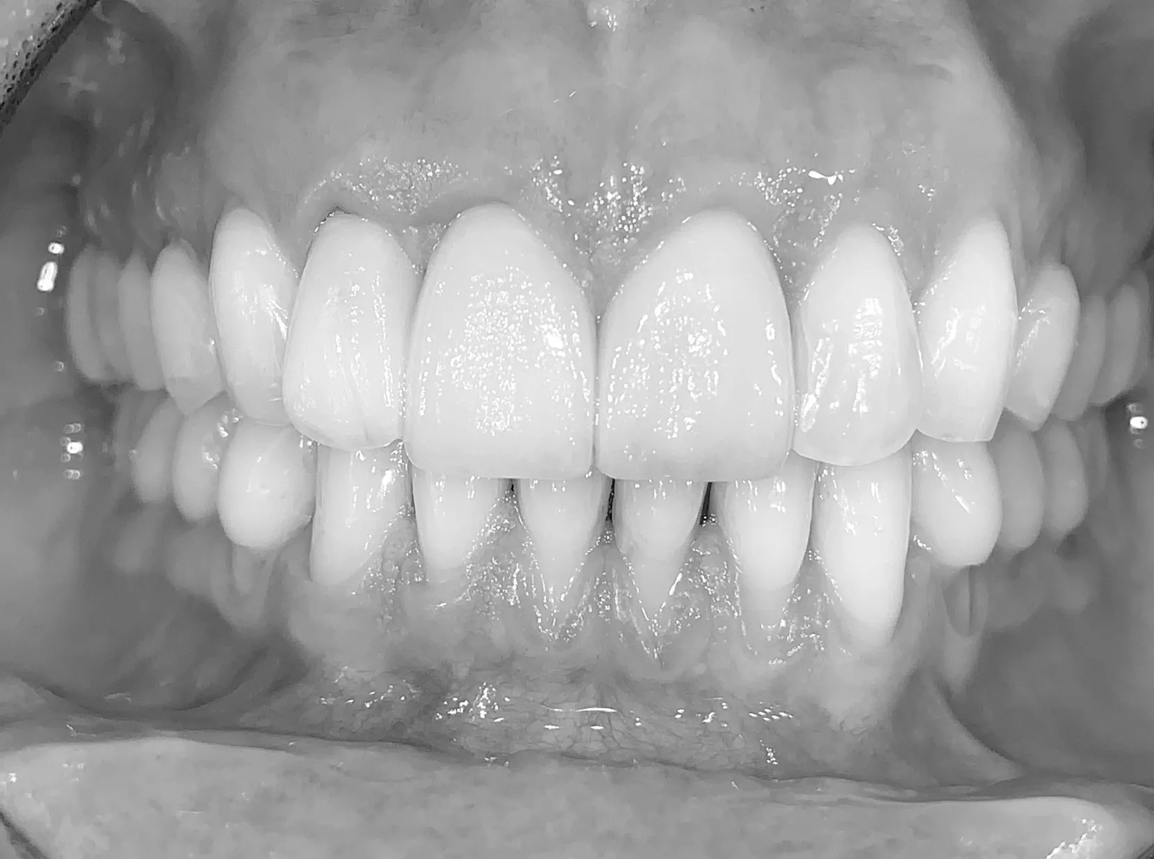 Orthodontie parodontale après traitement