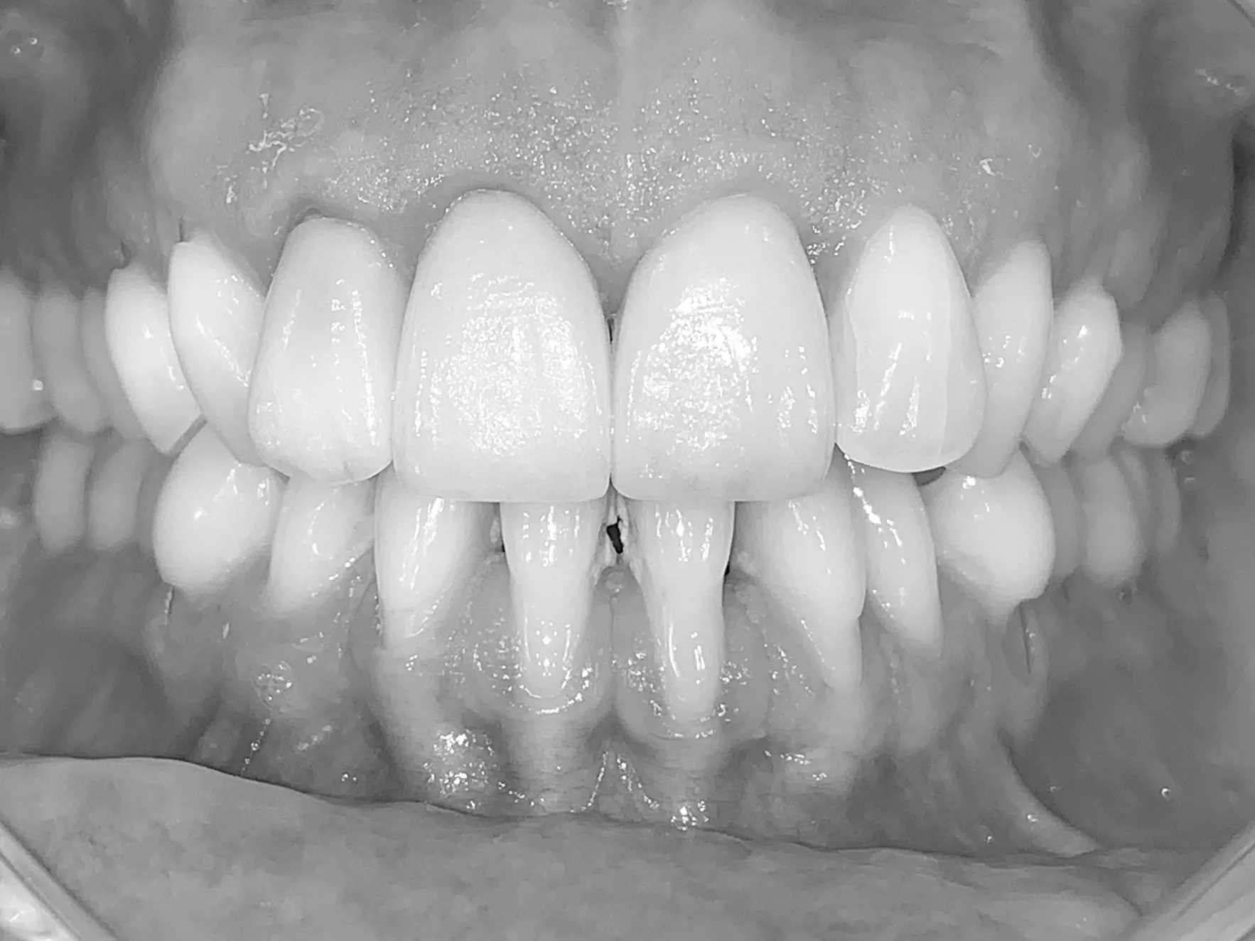 Orthodontie parodontale avant traitement
