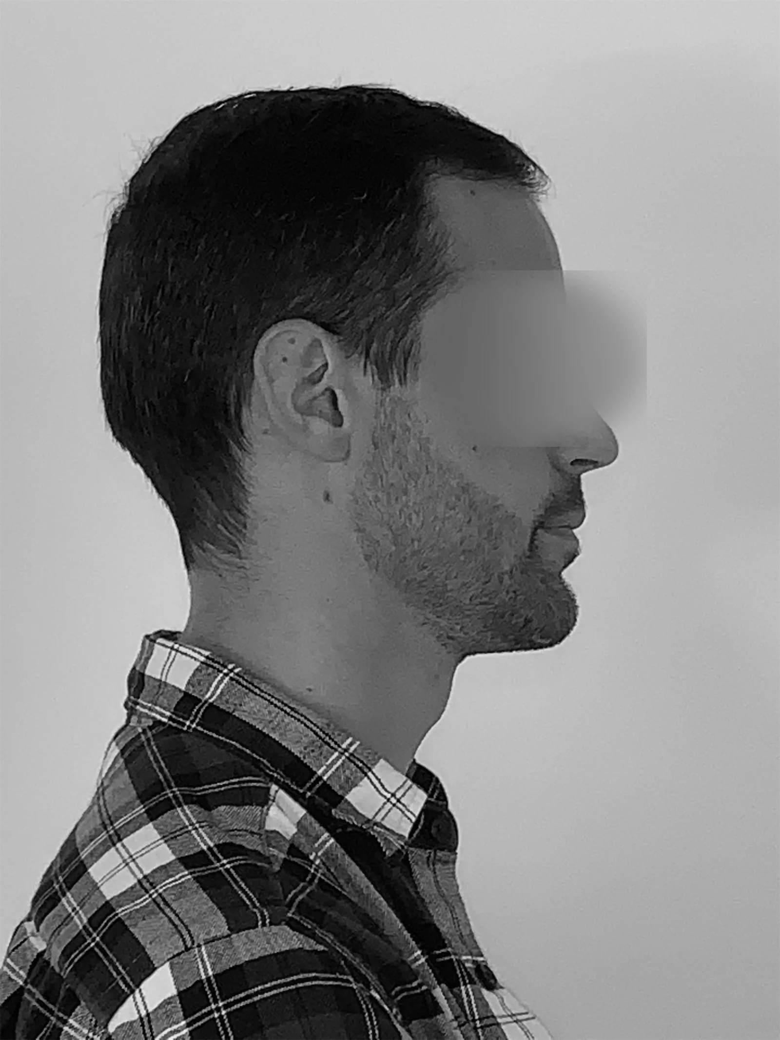 Profil facial après traitement chirurgical de prognathie mandibulaire
