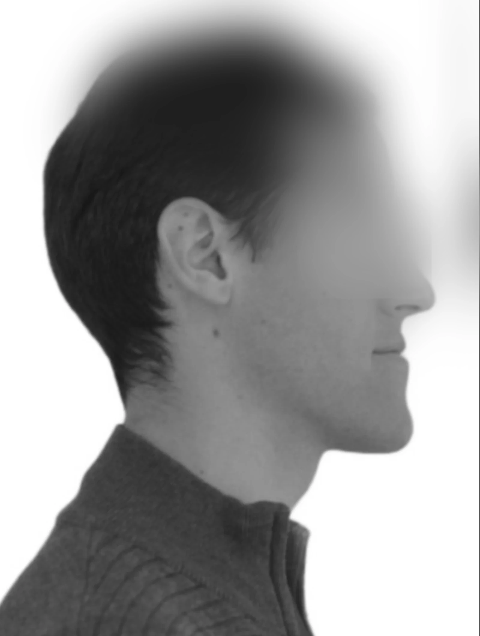 Profil facial avant traitement de prognathie mandibulaire