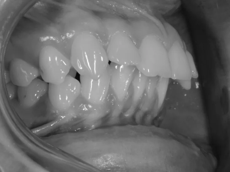 Occlusion droite avant traitement de rétrognathie