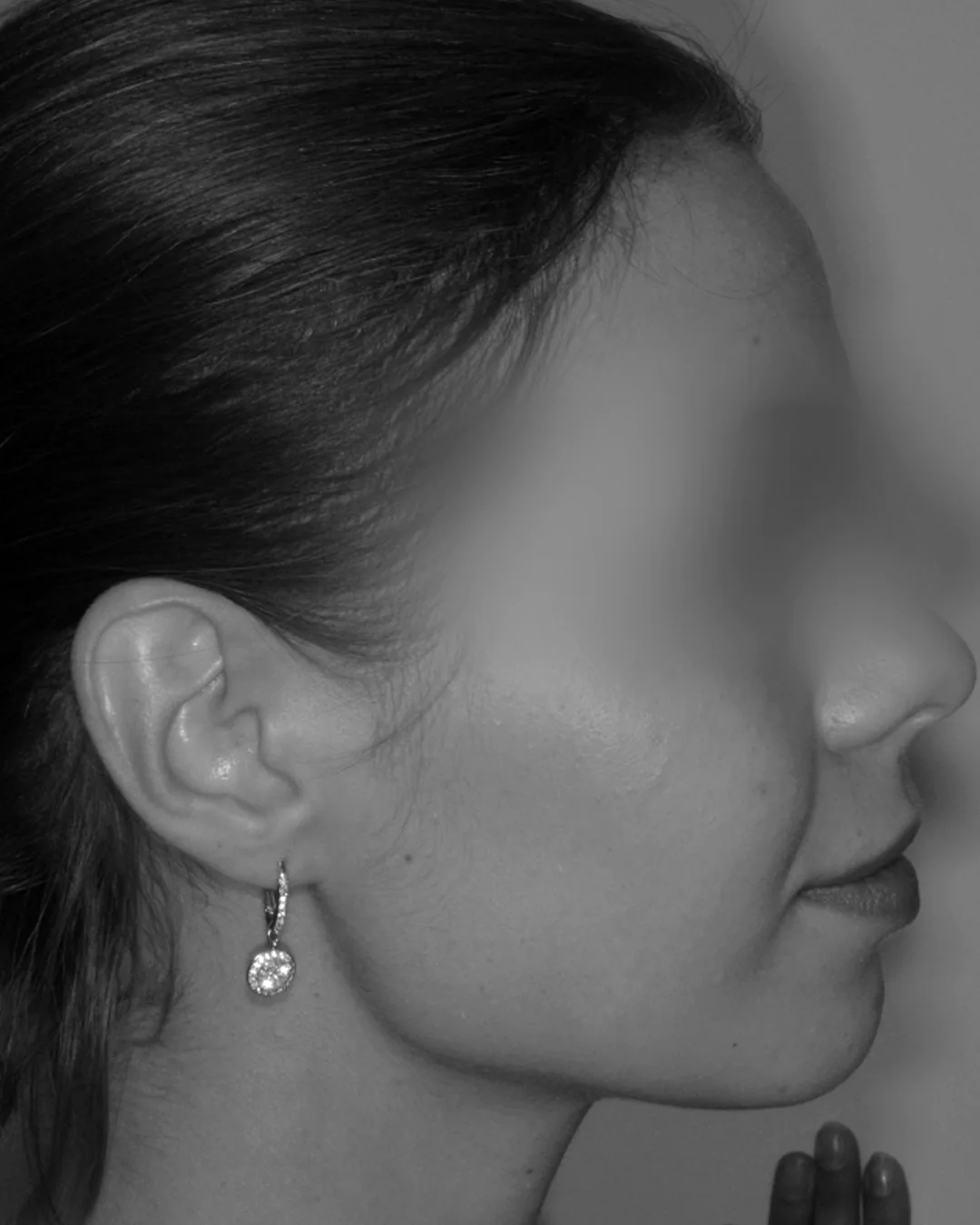 Profil facial après traitement chirurgical de rétrognathie mandibulaire