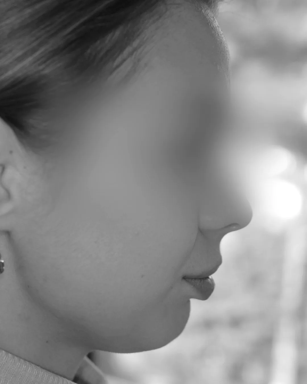 Profil facial avant traitement de rétrognathie mandibulaire